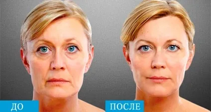 СМАС ліфтинг апаратний - підтяжка обличчя (підтяжка) СМАС ліфтинг апаратний - підтяжка обличчя