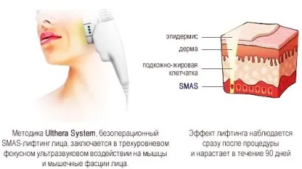 СМАС ліфтинг що це таке, відгуки