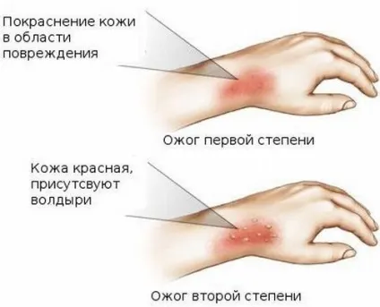 Сонячні опіки у дітей перша допомога, кошти для лікування і полегшення болю (дитячий крем, 1 (допомога) Сонячні опіки у дітей перша допомога, кошти для лікування і полегшення болю (дитячий крем, 1