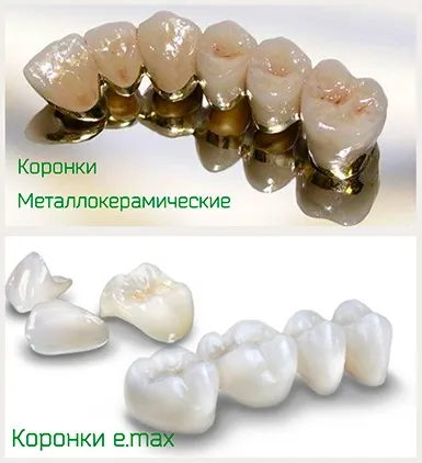 Сучасна прес кераміка, гід по стоматології