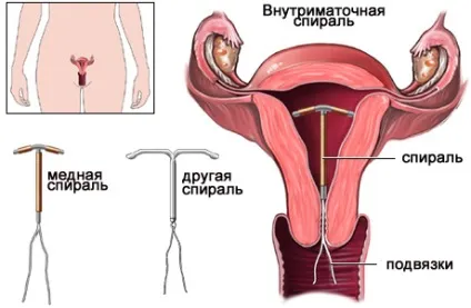 спіраль протизаплідна