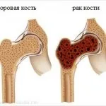 Ступені променевої хвороби