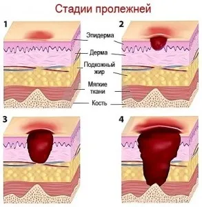 Стадії і лікування пролежнів на п'ятах і сідницях (пролежнів) Стадії і лікування пролежнів на п'ятах і сідницях