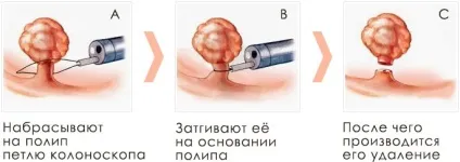 Поліп в вусі симптоми у дитини, лікування, видалення оперативним шляхом (видалення поліпа в вусі) Поліп в вусі симптоми у дитини, лікування, видалення оперативним шляхом