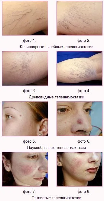 Телеангіектазії на обличчі, носі і щоках причини і лікування (патологія судини розширення зірочки прояв шкіра) Телеангіектазії на обличчі, носі і щоках причини і лікування