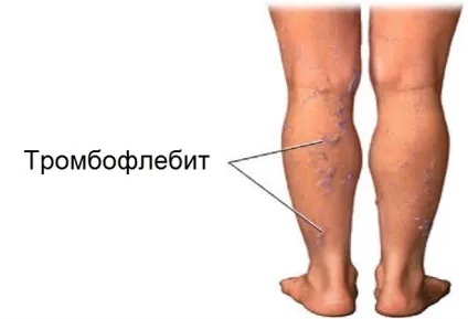 Тромбофлебіт лікування препарати, ліки, таблетки, що приймати (ліки) Тромбофлебіт лікування препарати, ліки, таблетки, що приймати