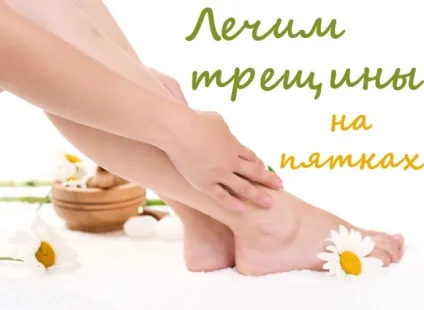 Тріщини на п'ятах лікування народними засобами (лікування) Тріщини на п'ятах лікування народними засобами