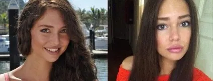 Учасниця шоу канікули в мексиці яна Сухова до і після операції (Сухова) Учасниця шоу канікули в мексиці яна Сухова до і після операції