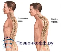 Вправи для виправлення кифоза (кіфозу) Вправи для виправлення кифоза