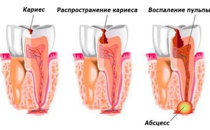 У дитини болить зуб - чим краще знеболити в домашніх умовах (домашніх) У дитини болить зуб - чим краще знеболити в домашніх умовах