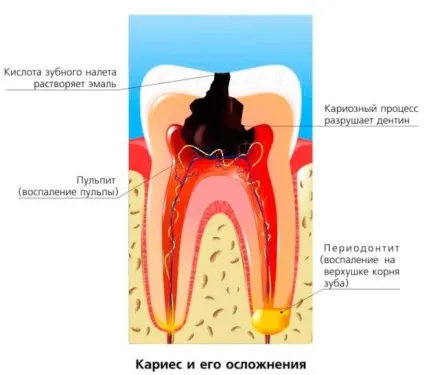 У дитини болить зуб - чим краще знеболити в домашніх умовах (болить) У дитини болить зуб - чим краще знеболити в домашніх умовах