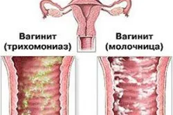 Вагинит - причини, ознаки, лікування