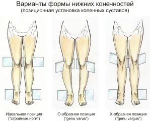 Вальгусна деформація колінних суглобів з фото (колінних) Вальгусна деформація колінних суглобів з фото