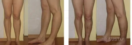 Вальгусна деформація колінних суглобів лікування вальгуса у дітей (фото) (колінних) Вальгусна деформація колінних суглобів лікування вальгуса у дітей (фото)