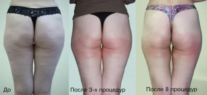 Вакуумний масаж від целюліту як користуватися антицелюлітний масажером, відгуки, фото,