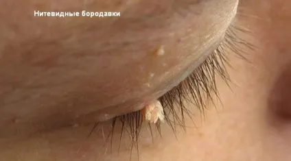 У чому відмінність кондиломи і папіломи і як їх правильно лікують (мазі) У чому відмінність кондиломи і папіломи і як їх правильно лікують