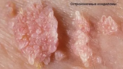 У чому відмінність кондиломи і папіломи і як їх правильно лікують (папіломи) У чому відмінність кондиломи і папіломи і як їх правильно лікують