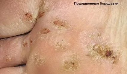У чому відмінність кондиломи і папіломи і як їх правильно лікують (припікання електрикою) У чому відмінність кондиломи і папіломи і як їх правильно лікують
