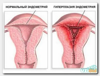 Узі при ендометріозі на який день циклу видно (ендометріоз) Узі при ендометріозі на який день циклу видно