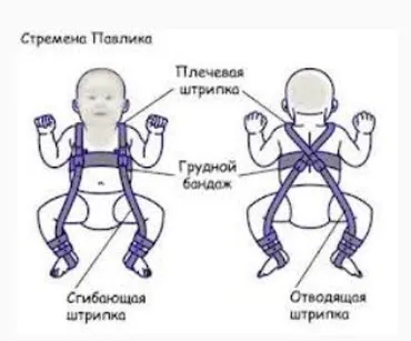 Дисплазія тазостегнових суглобів у новонароджених, 1, 2, 3 спепені дисплазії, симптоми і лікування (узі тазостегнових суглобів) Дисплазія тазостегнових суглобів у новонароджених, 1, 2, 3 спепені дисплазії, симптоми і лікування