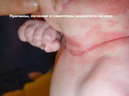 Дерматит на шиї причини появи у дорослих і дітей, лікування (дітей) Дерматит на шиї причини появи у дорослих і дітей, лікування