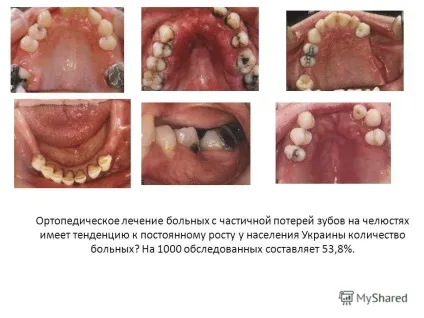 Презентація на тему актуальність естетичними і низькоефективними конструкціями серед знімних (серед) Презентація на тему актуальність естетичними і низькоефективними конструкціями серед знімних