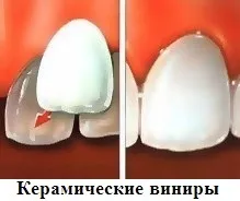 Види виниров - які бувають (керамічні, композитні, порцелянові) і які кращі (виниров) Види виниров - які бувають (керамічні, композитні, порцелянові) і які кращі