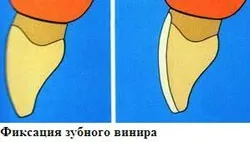 Види виниров - які бувають (керамічні, композитні, порцелянові) і які кращі (види) Види виниров - які бувають (керамічні, композитні, порцелянові) і які кращі