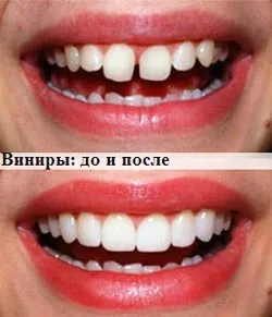 Види виниров - які бувають (керамічні, композитні, порцелянові) і які кращі (виниров) Види виниров - які бувають (керамічні, композитні, порцелянові) і які кращі