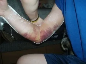 Вивих ліктьового суглоба причини, симптоми, лікування і реабілітація (вивих ліктя) Вивих ліктьового суглоба причини, симптоми, лікування і реабілітація