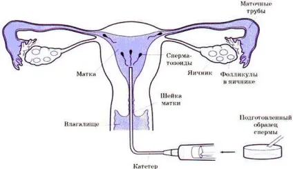Внутрішньоматкова інсемінація, чекаю дитину (інсемінація фото) Внутрішньоматкова інсемінація, чекаю дитину