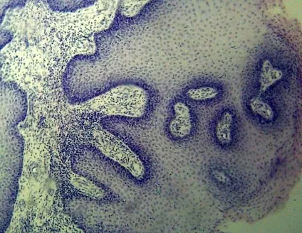 Вірус папіломи людини лікування, причини, діагностика hpv, science debate (вірус) Вірус папіломи людини лікування, причини, діагностика hpv, science debate