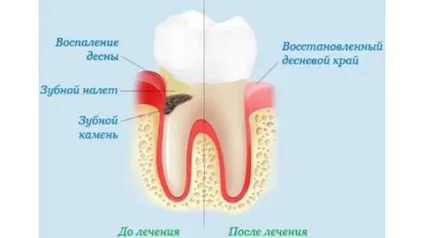 Запалення ясен у дітей лікування і причини появи порушення (лікування) Запалення ясен у дітей лікування і причини появи порушення