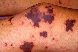 Все про висипки у дітей і дорослих та її лікування (дорослих) Все про висипки у дітей і дорослих та її лікування