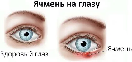 Ячмінь на оці причини прояви і як швидко лікувати вдома (причини) Ячмінь на оці причини прояви і як швидко лікувати вдома