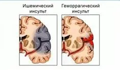Захворювання серця повідомлення - лікування серця (захворювання) Захворювання серця повідомлення - лікування серця