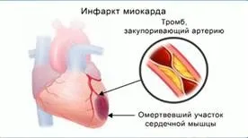 Захворювання серця повідомлення - лікування серця (попередження захворювань серця) Захворювання серця повідомлення - лікування серця
