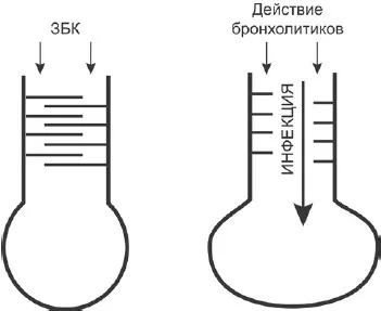 Захисна бронхоконстрикция при бронхіальній астмі