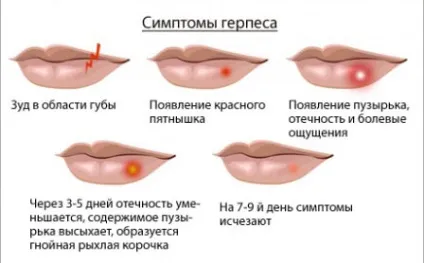 Зубна паста від герпесу на губах лікування, чи допомагає (губах) Зубна паста від герпесу на губах лікування, чи допомагає