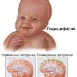 Причини неиммунной водянки плода - скальпель - медичний інформаційно-освітній портал