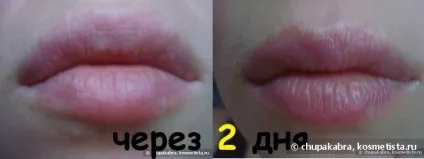 Про купероз і вибір догляду і процедури для сухої шкіри, схильної до почервоніння і куперозу, 25, 30 - (догляд за особою) Про купероз і вибір догляду і процедури для сухої шкіри, схильної до почервоніння і куперозу, 25, 30 -