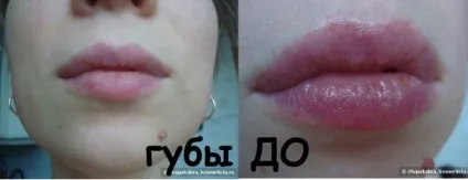 Про купероз і вибір догляду і процедури для сухої шкіри, схильної до почервоніння і куперозу, 25, 30 - (догляд за губами) Про купероз і вибір догляду і процедури для сухої шкіри, схильної до почервоніння і куперозу, 25, 30 -