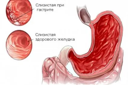 Напад гастриту симптоми, перша допомога, як зняти (напад) Напад гастриту симптоми, перша допомога, як зняти