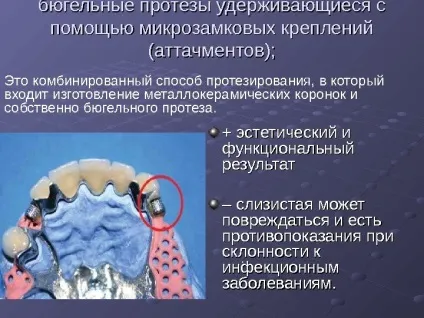 Протезування бюгельнимі протезами