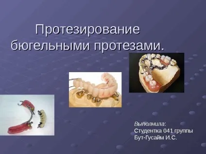 Протезування бюгельнимі протезами