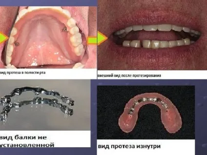 Протезування бюгельнимі протезами