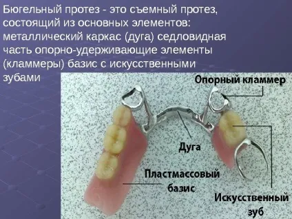 Протезування бюгельнимі протезами