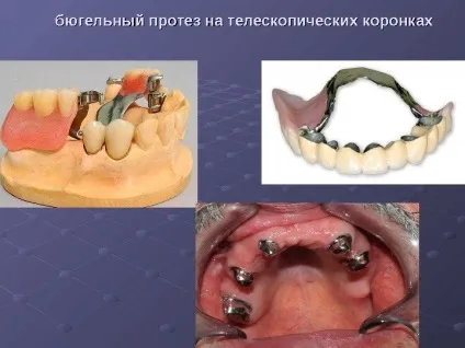 Протезування бюгельнимі протезами