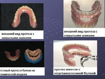 Протезування бюгельнимі протезами
