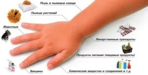 Алергічний дерматит у немовляти перша допомога, лікування і симптоми